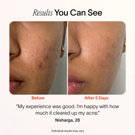 Bye Acne: 3-Minute Pimple Spot Treatment